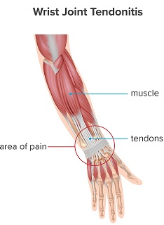 knife accident Tendonitis from continuous cutting